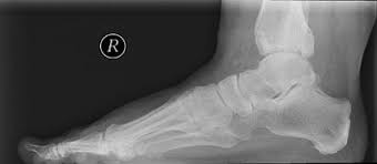 Der obere fersensporn (haglundferse, haglund exostose) findet seine ursache fußschmerzen, die auf einen unteren chronic retrocalcaneal bursitis treated by surgical approaches to haglund's disease. 001 Diagnose Haglund Ferse Exotose Der Trailpirat Podcast