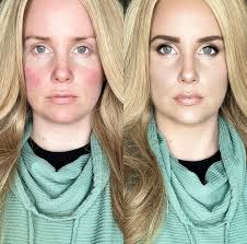 Aspen contour for redness correction and highlighting