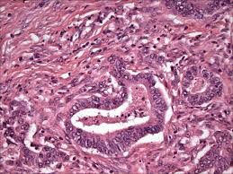 Symptoms of colon cancer include changes in bowel habits and unexplained abdominal pain. How Can I Tell The Difference Between Irritable Bowel Syndrome And Colorectal Cancer Dana Farber Cancer Institute