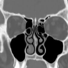 This is formed by lateral and posterior pneumatization of the most posterior ethmoid cells over the sphenoid sinus. Haller Cell Radiology Case Radiopaedia Org