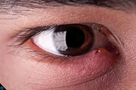 Parasitas nos olhos de uma pessoa causam doenças oftalmológicas. Atencao Descubra 5 Causas Para O Olho Vermelho E Dolorido
