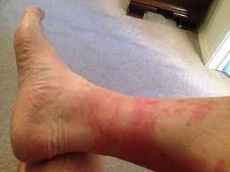 Disney Rash What It Is How To Treat It How To Prevent It In The First Place Your Mileage May Vary