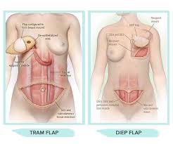 Pin On Infographics Plastic Surgery