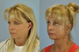 Eyelid Surgery Gallery