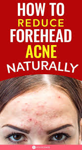 .how to get rid of acne scars with home remedies for acne & implementing hormonal balancing tips for acne treatments! How To Get Rid Of Pimples On Forehead In 2021 Forehead Acne Pimples On Forehead Forehead Bumps