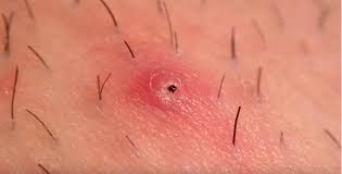 For this, you will have to mix one tablespoon of gram flour with salt water. How To Remove Private Part Hair 2021 Immunity Booster Fitness Blog