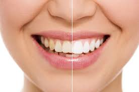 It often refers, specifically, to a dilute solution of sodium hypochlorite, also called liquid bleach. Bleaching Professionell Schonend Axel Lorke In Wurzburg