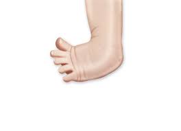 The symptoms of clubfoot vary but are easy to identify by a medical professional. What Is Clubfoot Juniortho