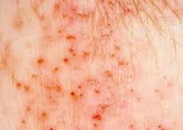 Image result for pubic lice symptoms