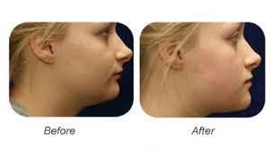 However, the success rate for surgery is high, and failures usually occur from infections, medications, and allergies. Mara Dr Brock Rondeau Associates