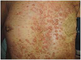 Rapid onset of skin erythema and induration and asymmetric enlargement and is often not associated with a. Multiple Neurofibromas On The Skin The Left Sided Breast Cancer Was Download Scientific Diagram
