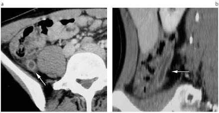 Hallazgos Tomográficos De Apendicitis Aguda Con Engrosamiento Y Estriación Grasa, Generada Por Ia