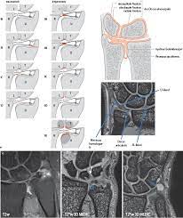 Triangular fibrocartilage complex, abgekürzt tfcc; Bildgebung Der Hand Springerlink