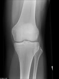 Sind zusätzlich zum vorderen kreuzband, der innenmeniskus sowie das innere seitenband verletzt. Die Innenbandzerrung Des Kniegelenkes Beim Skifahren Orthopadische Praxis Dr Kruijer Oberstdorf