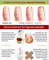 Other ways you can stop an ingrown toenail becoming. Proper Way To Trim Toe Nails Prevent Ingrown Toe Nails Ingrown Toe Nail Toe Nails