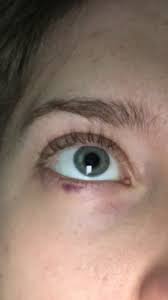Lila Streifen Unter Denn Auge Was Ist Das Haut Augen