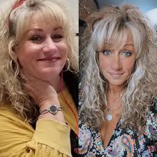 After being diagnosed with vitiligo as a teenager and by 35 having no  pigment left, I knew I probably was destined to have another auto  condition. What else I didn't realize that