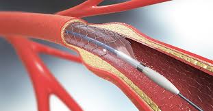 Endoscopic stenting