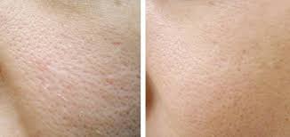 Les Pores Sont Les Petits Trous Quand Ils Sont Tres Ouverts Ils Ressemblent A Une Peau D Orange Il Existe De Nombreuses Big Pores Face Pores Large Pores