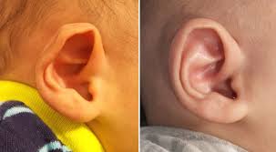 Infant Ear Molding