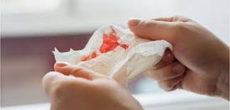 Untuk itu jika terjadi pendarahan pada. Doktor Ini Kongsi 10 Sebab Mengapa Hidung Berdarah Dengan Kerap Walaupun Fizikal Kelihatan Sihat