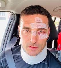 Lionel scaloni, el técnico de la selección argentina, que actualmente esta siendo muy criticado por el país argentino, a causa del rendimiento del equipo en. Los Memes Tras El Accidente De Lionel Scaloni Sol 91 5