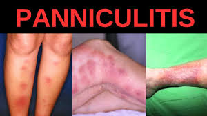 Image result for Panniculitis