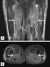 They also layer well with other lights, opening up creative possibilities in your home. Cureus Statin Induced Immune Mediated Necrotizing Myopathy An Increasingly Recognized Inflammatory Myopathy