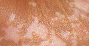 7 Issues That Cause Brown Patches On Skin Vitiligo Cure White Patches Vitiligo