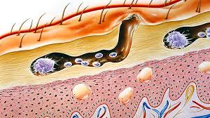 Image result for scabies human children