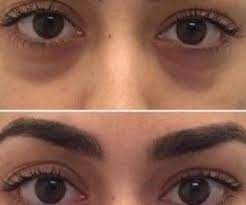 تخلصت من الهالات السوداء في أقل من 15 يوم booking appointments general hospital appointments