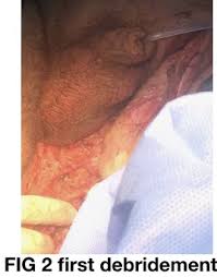 Alcides chaux, m.d., antonio l. Npwt I D In Combined Surgical Treatment For Fournier S Disease Npwt Instillation