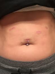 I answered many of them here, but there were too many to fit in 1 post so today i am answering some more.i will also be going into much greater detail soon! How Are Your Scars Looking I M Almost 6 Weeks Post Vsg I Don T Actually Care About Scars That Much Just Curious How Yours Look After 6 Months 1 Year Wls