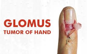 Image result for Glomus tumor