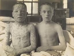 Image result for Smallpox