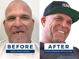 Patient's Unfiltered Review of the Side Effects of Dental Implants