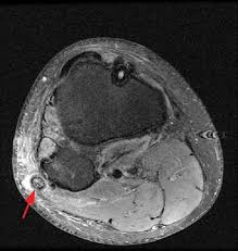 The tendon of the subscapularis muscle attaches both to the on mr an os acromiale is best seen on superior axial images. Common Peroneal Nerve Abnormalities Radsource