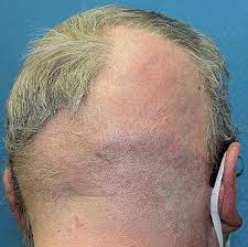 Eventually, symptoms may include any of the following: Cicatricial Alopecia Related To Folliculotropic Mycosis Fungoides Springerlink
