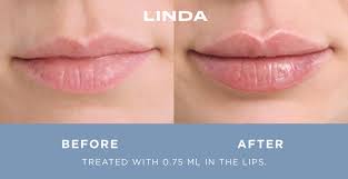 Our unique concierge approach to aesthetics brings expert providers to the places you already go for beauty and body. Restylane Family Refresh Aesthetic Center