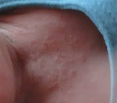 Sudamina Ronchitas De La Piel Del Bebe Ocasionadas Por La Calor Madres Hoy