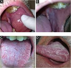 Image result for Leukoedema