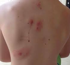 Infestation by larvae of the human botfly (dermatobia hominis) and tumbu fly (cordylobia anthropophaga) in endemic areas, d. When Unusual Problems Present Always Ask About Travel