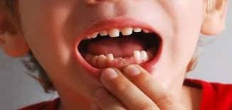 تفسير سقوط الأسنان في المنام لإبن سيرين teeth
