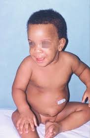 Access for Enteral Nutrition