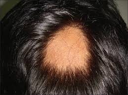 Minor stress can cause hair loss. Indian Journal Of Dermatology Venereology And Leprology Alopecia Areata An Update