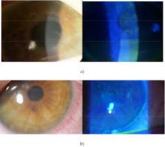 Noninfectious keratitis can be caused by a relatively minor injury, by wearing your contact lenses too long or by a. Keratitis A Clinical Approach Intechopen