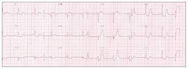 Tutorial site on clinical electrocardiography (ecg). De Winter Syndrome Cmaj