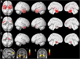 I'd better be putting my grey matter into that algebra instead of wasting it plotting for a party dress that i certainly can't get.. Changes In Gray Matter Volume And Functional Connectivity In Dementia With Lewy Bodies Compared To Alzheimer S Disease And Normal Aging Implications For Fluctuations Alzheimer S Research Therapy Full Text