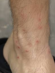 Image result for mite bites on humans