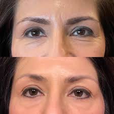 Tara Bertoldo, NP • Botox • Filler • Georgetown TX (@tara.b.np) • Instagram  photos and videos